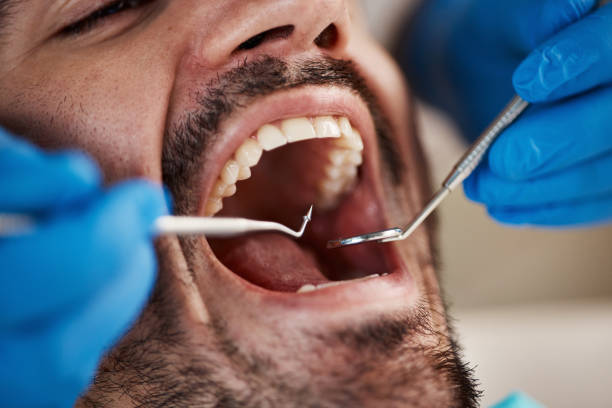 Best Emergency Wisdom Tooth Extraction in Linthicum, MD